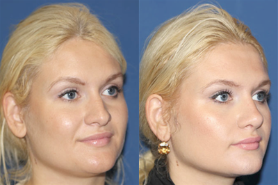 Rhinoplasty before and after photo