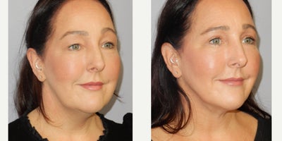 before and after image