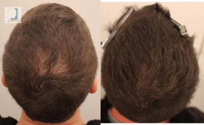 PRP for Hair Loss before and after photo