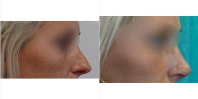 Rhinoplasty before and after photo