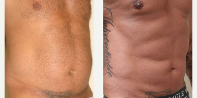 Smart Lipo before and after photo