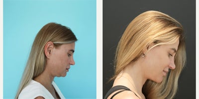 Neck Lift before and after photo
