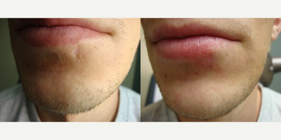 Subcision before and after photo