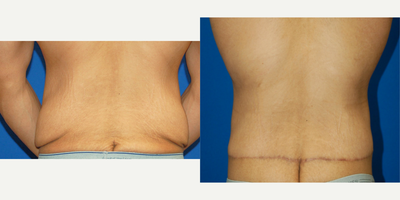 Body Lift before and after photo