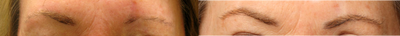 Eyebrow Transplant before and after photo