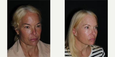 Eyelid Surgery before and after photo