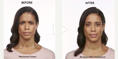 Jeuveau before and after photo
