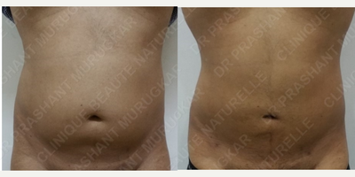 Liposuction before and after photo