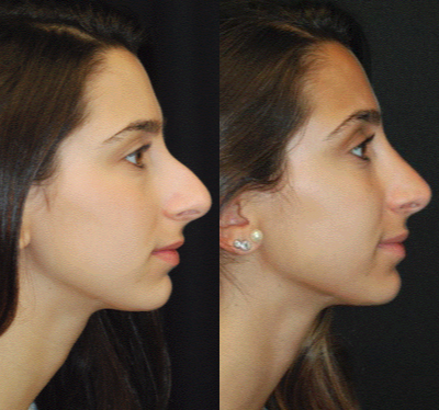 Rhinoplasty before and after photo