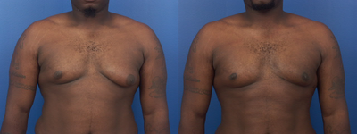 Gynecomastia Surgery before and after photo