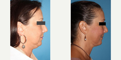 Neck Lift before and after photo