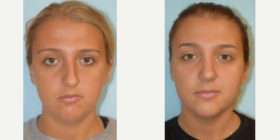 Rhinoplasty before and after photo