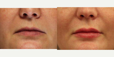 Volbella before and after photo