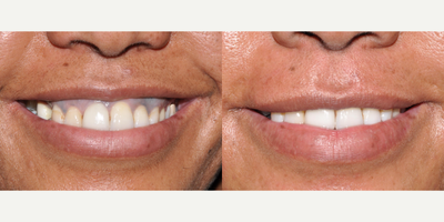 Botox before and after photo