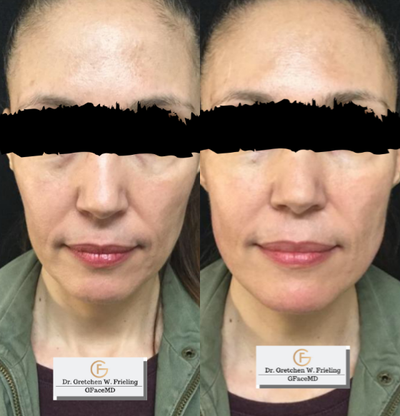 Dermal Fillers before and after photo