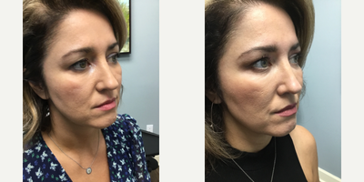 Dermal Fillers before and after photo