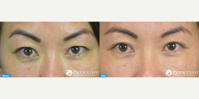 Double Eyelid Surgery before and after photo