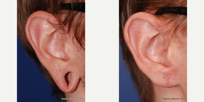 Earlobe Repair before and after photo