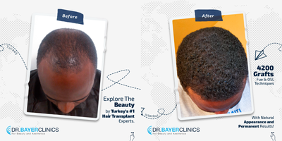 Hair Transplant before and after photo