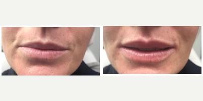 Lip Fillers before and after photo