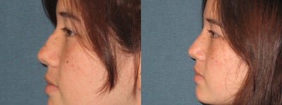 Rhinoplasty before and after photo