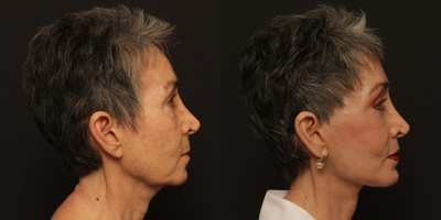 Skin Rejuvenation before and after photo