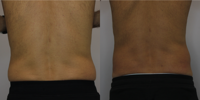 Skin Tightening before and after photo