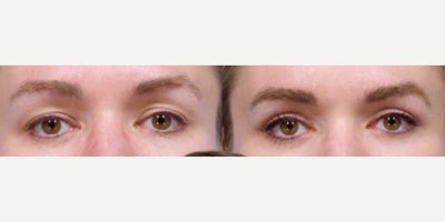 Brow Lift before and after photo