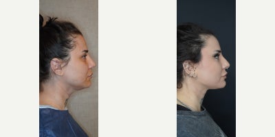 Brow Lift before and after photo