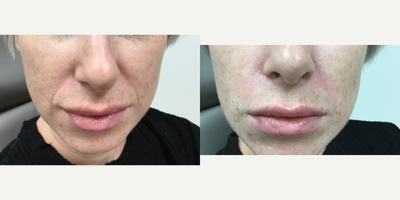 Dermal Fillers before and after photo