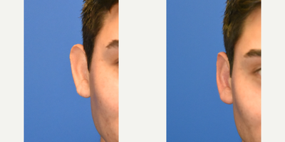 Ear Surgery before and after photo