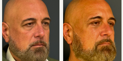 Eyelid Surgery before and after photo