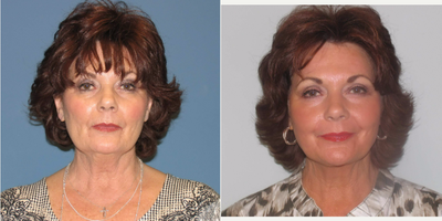 Facelift before and after photo