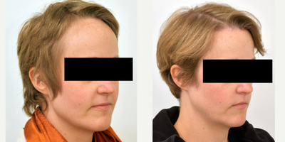 Forehead Reduction before and after photo
