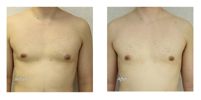 Gynecomastia Surgery before and after photo