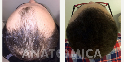 Hair Transplant before and after photo