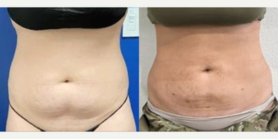 Liposuction before and after photo