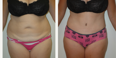 Tummy Tuck before and after photo
