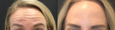 Botox before and after photo
