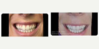 Botox for Gummy Smile before and after photo