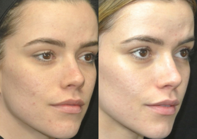 IPL before and after photo