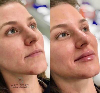 Lip Fillers before and after photo