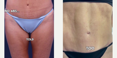 Liposuction before and after photo