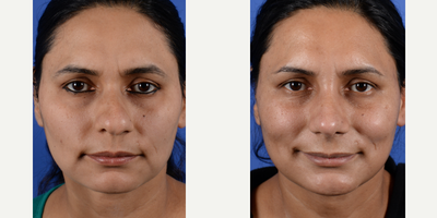 Rhinoplasty before and after photo