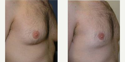 Smart Lipo before and after photo