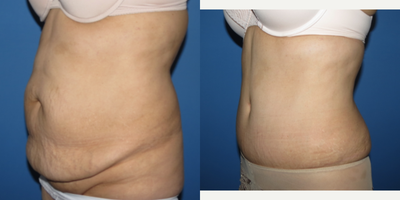 Tummy Tuck before and after photo