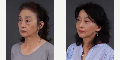 Eyelid Surgery before and after photo