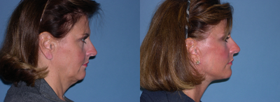Facelift before and after photo