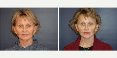 Facelift before and after photo