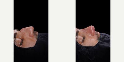 Rhinoplasty before and after photo